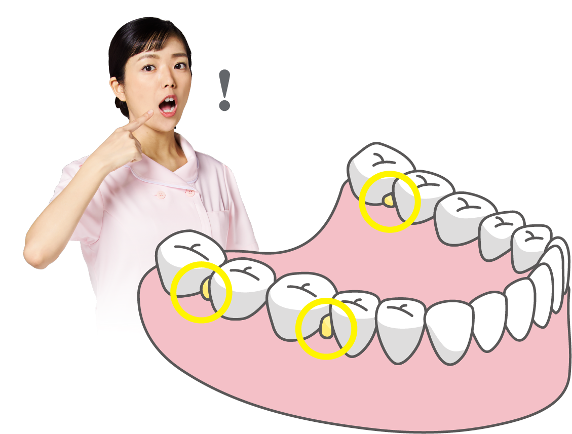 奥歯の歯周プラーク（歯垢）に要注意！​