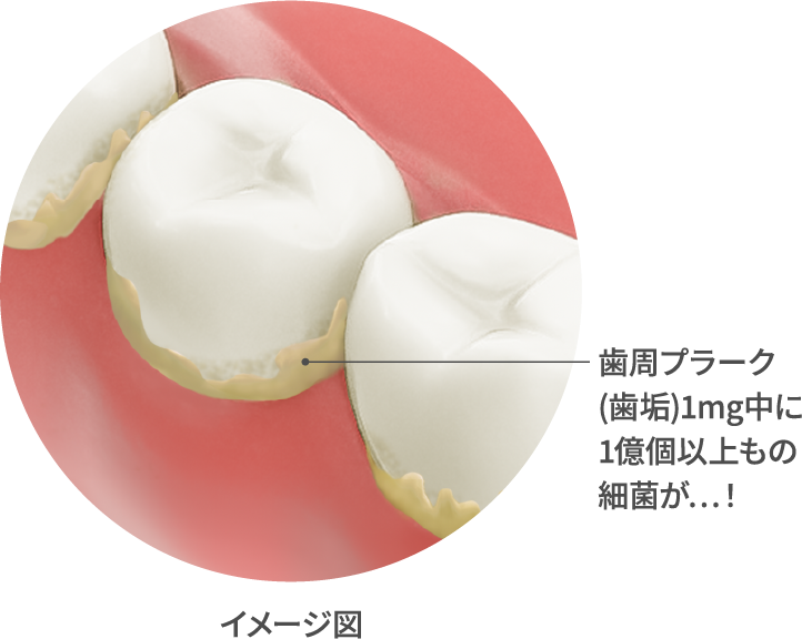 イメージ図 歯周プラーク(歯垢)1mg中に1億個以上もの細菌が...!