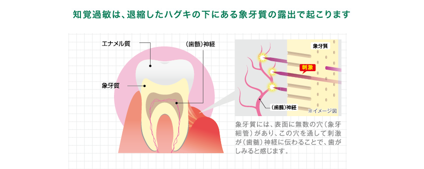 知覚過敏は、退縮したハグキの下にある象牙質の露出で起こります 歯とハグキの断面図（イメージ図） 歯周病などによるハグキの退縮で、刺激を受けやすい象牙質が露出することで起こります。 象牙質拡大図（イメージ図） 象牙質には、表面に無数の穴（象牙細管）があり、この穴を通して刺激が（歯髄）神経に伝わり、歯がしみると感じます。