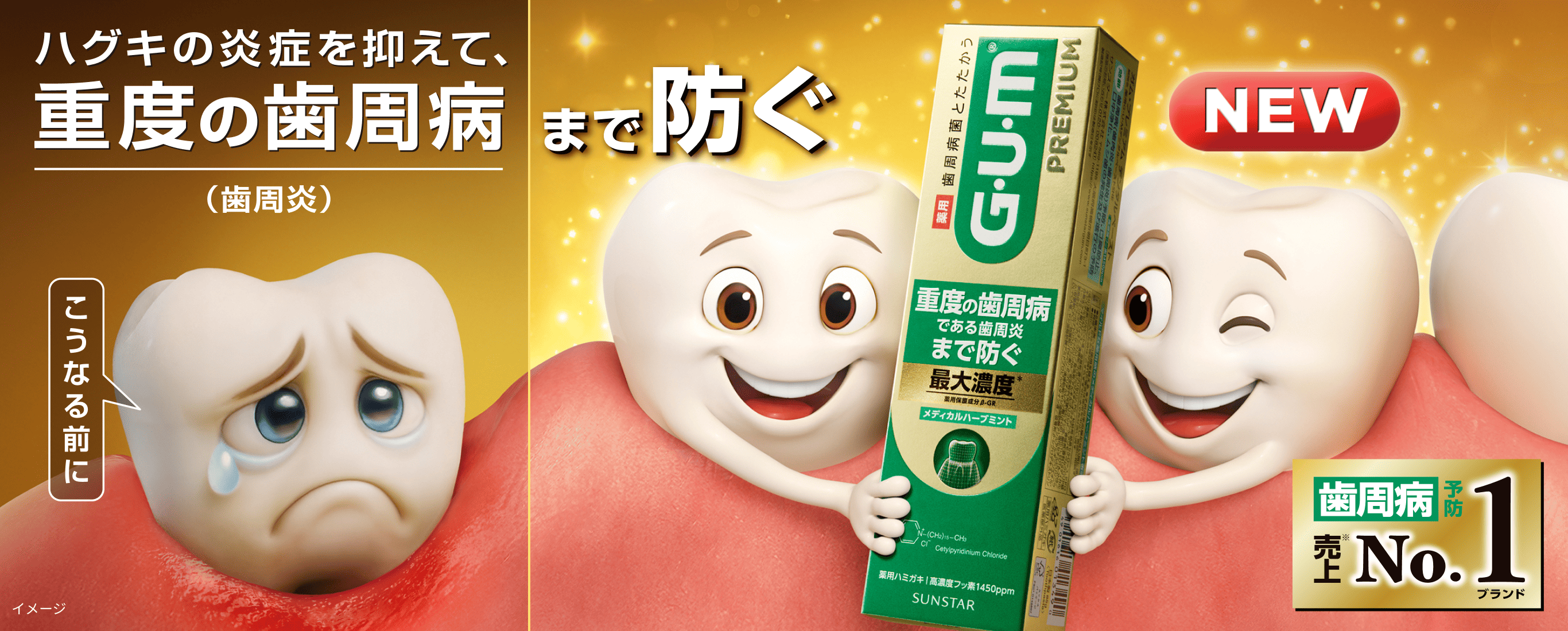 ハグキの炎症を抑えて、重度の歯周病(歯周炎)まで防ぐ