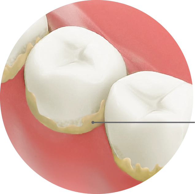 歯周プラーク